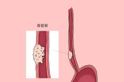 重庆中医肿瘤有名老中医:食管癌的并发症有多厉害,中医治疗效果好吗