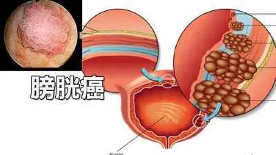 重庆有名中医肿瘤医师:膀胱癌做什么检查可以准确查出