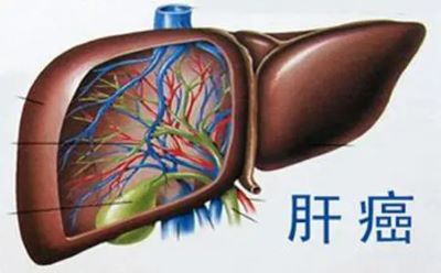 重庆中医肿瘤专家:中医在肝癌的治疗中,发挥着越来越大的作用