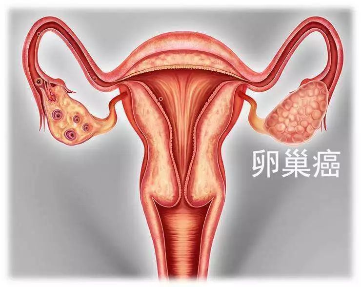 不可不知的关于卵巢癌的4大症状！