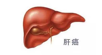 重庆中医罗登祥为大家介绍一下肝癌“爱找”的五类人