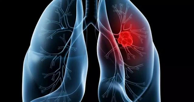 重庆肺癌科医院|中西医结合治疗的出现,助力肺癌患者带瘤生存!