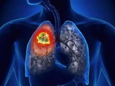 重庆中医肿瘤医师:肺癌复发的原因是什么?中医可以治疗吗